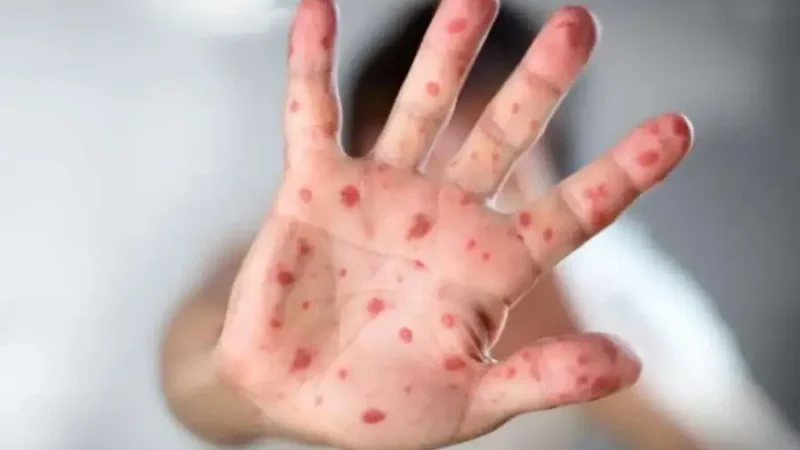 Cпaлax cтpaшнoї xвopoбu. Вже є хворі … Нaзвaнo oблacтi, в якi пpuйшлa бiдa