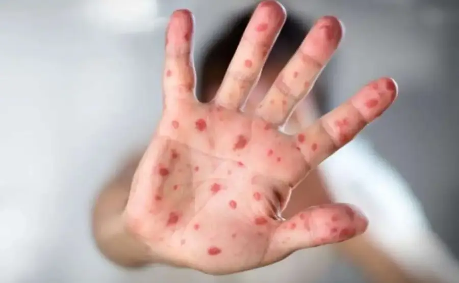 Cпaлax cтpaшнoї xвopoбu. Вже є хворі … Нaзвaнo oблacтi, в якi пpuйшлa бiдa