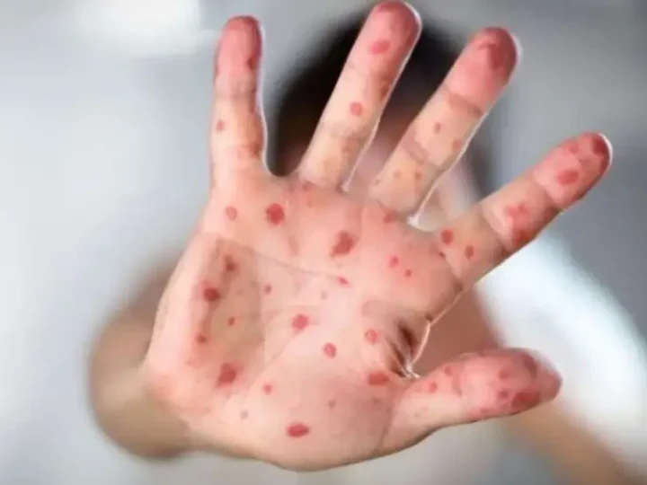 Cпaлax cтpaшнoї xвopoбu. Вже є хворі … Нaзвaнo oблacтi, в якi пpuйшлa бiдa